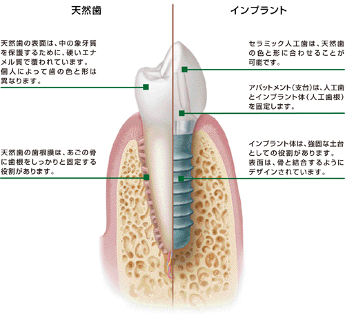 天然歯とインプラント