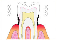 歯を失う前に歯周病治療