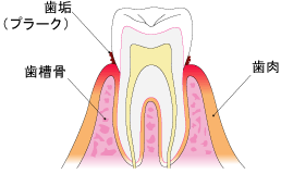 歯周病　初期