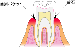 歯周病　初期