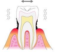 歯周病　中等度
