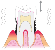 歯周病　重度